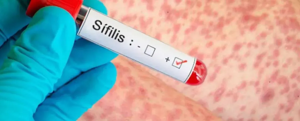 sifilis